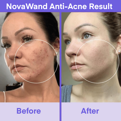 NovaWand™ High Frequency Wand